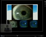 Restoring sight with cell transplantation to the retina